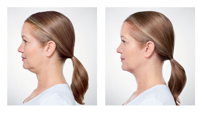 Get Rid of Double Chin with Kybella Treatment