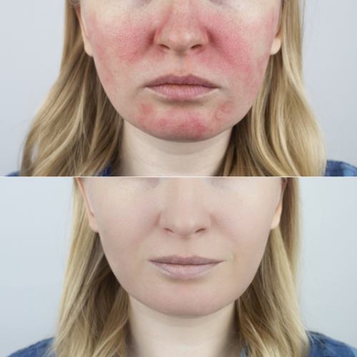 Rosacea ipl Treatment