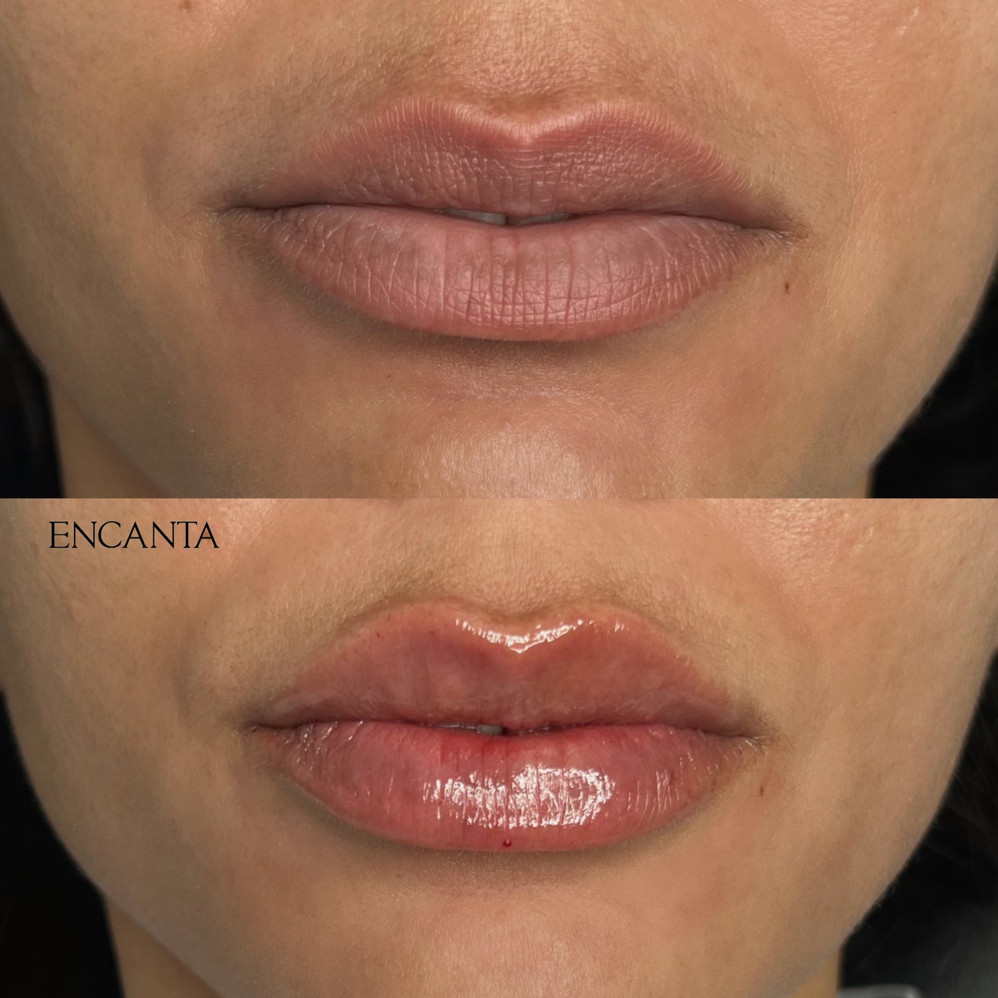 Lip Augmentation
