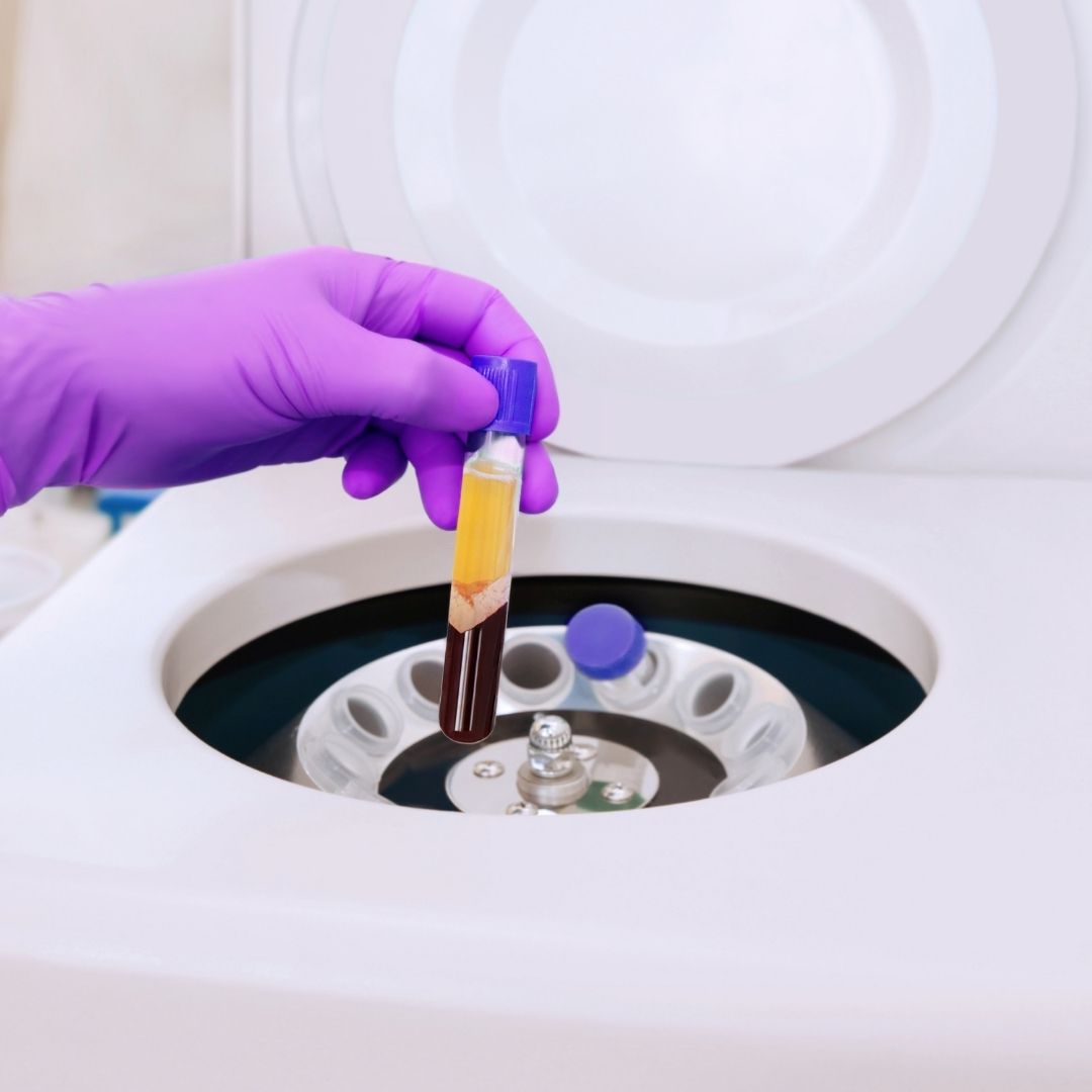 Platelets Rich Plasma (PRP)