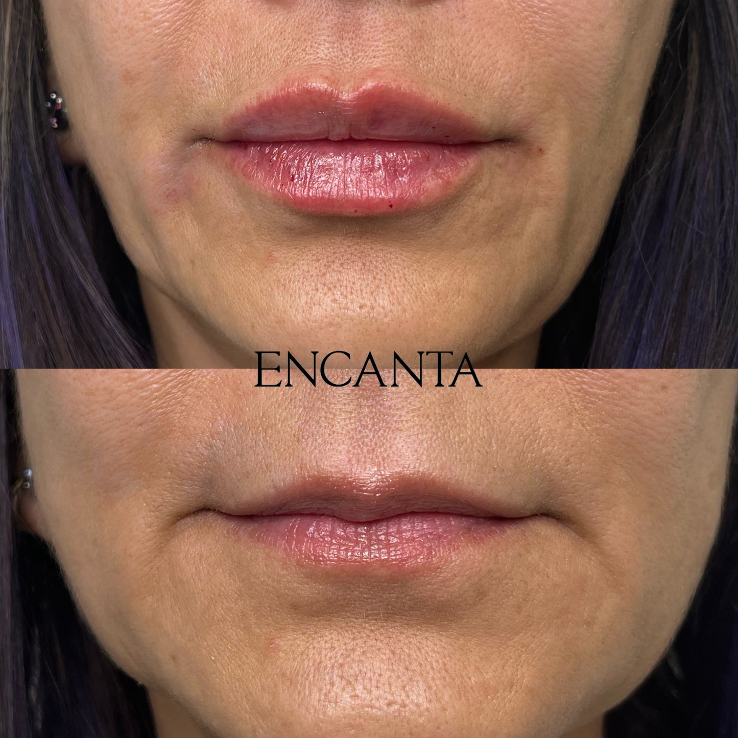 Lip Augmentation