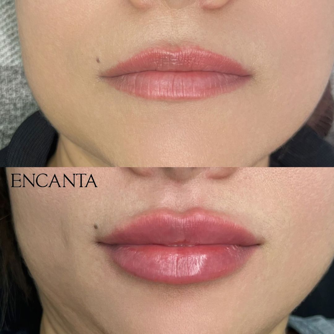 Lip Augmentation