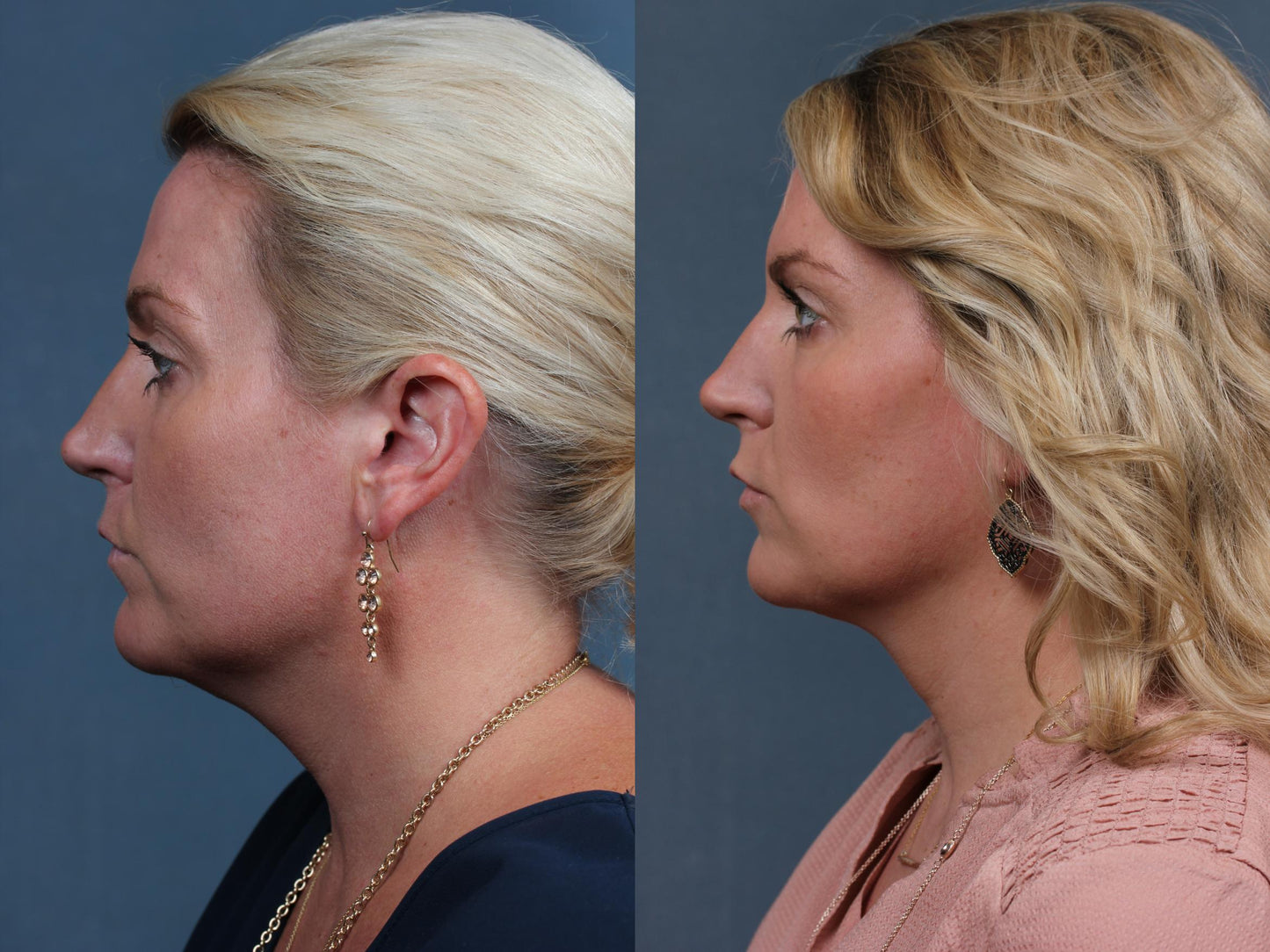 Double Chin Reduction Kybella | Chin Removal | Encanta Cejas