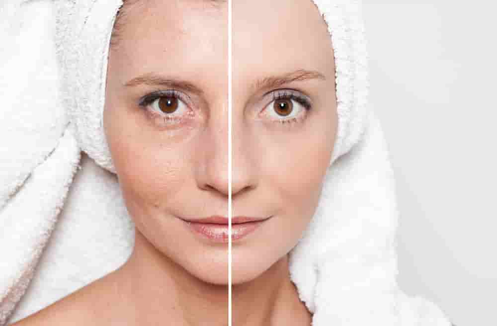 Skin Resurfacing