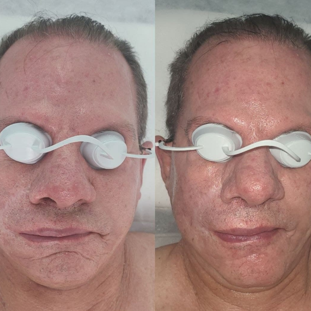 Skin Laser Treatments