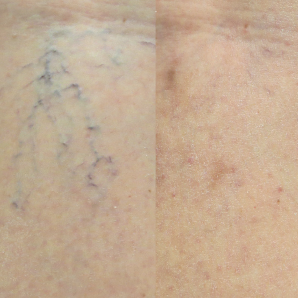 Vein Treatment