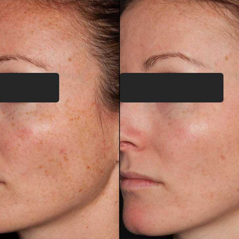 Solutions for Melasma