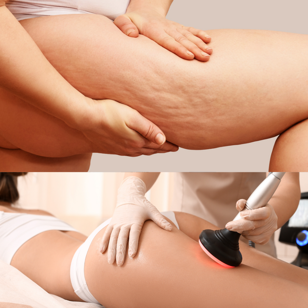 Cellulite Treatment