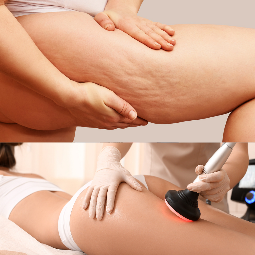 cellulite reduction massages