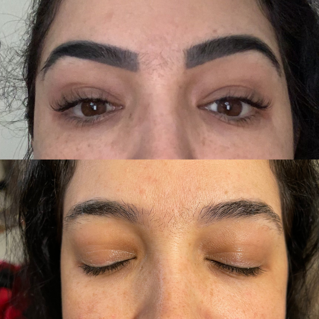 
                  
                    eyebrow tattoo removal Rochester Hills before and after
                  
                